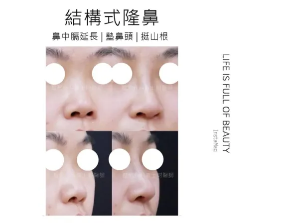 隆鼻